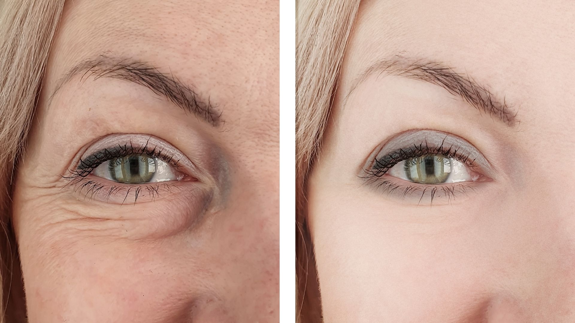Blepharoplasty before and after-1