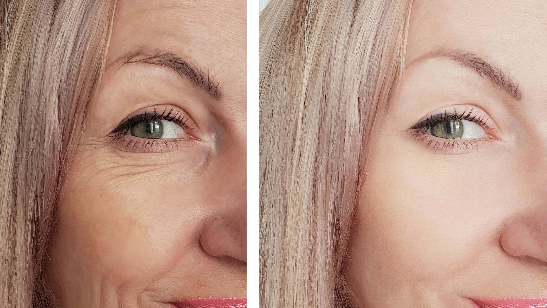 Blepharoplasty before and after-2