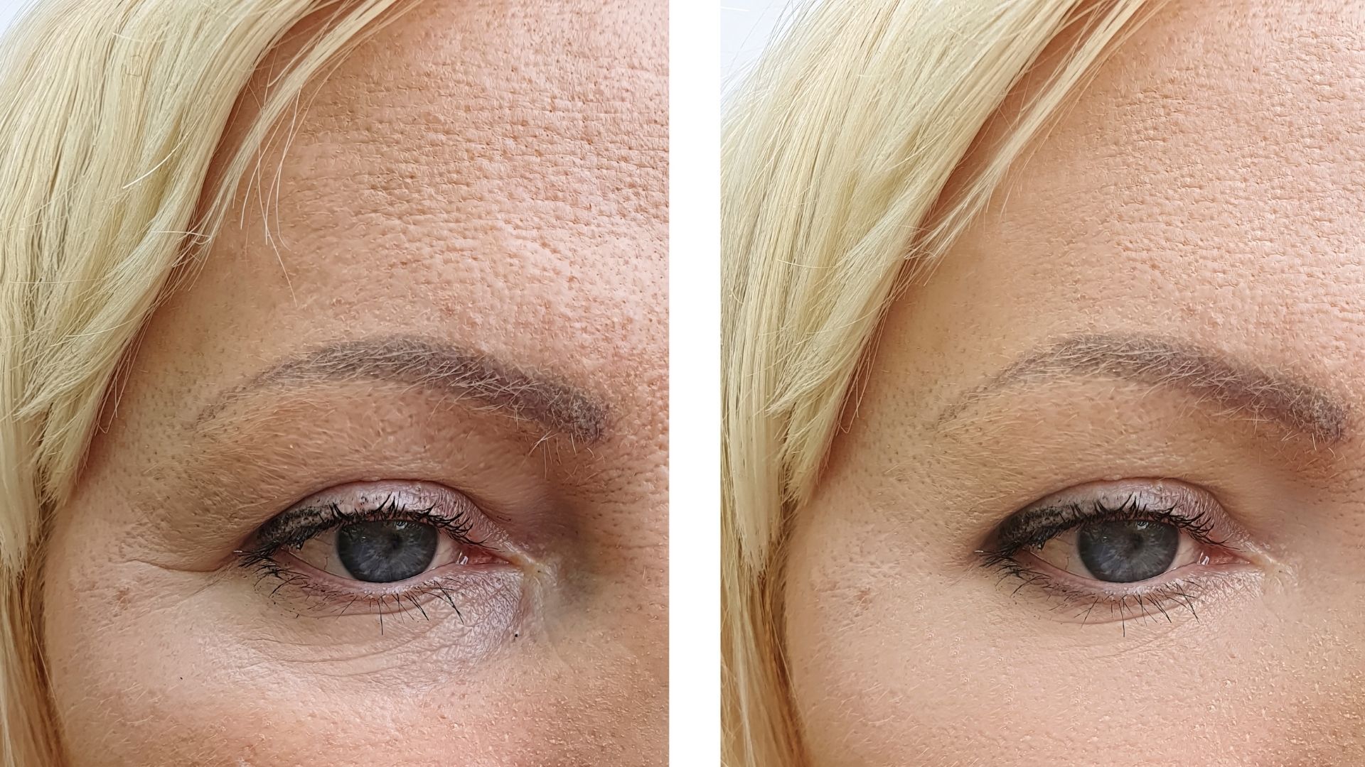 Blepharoplasty before and after-3