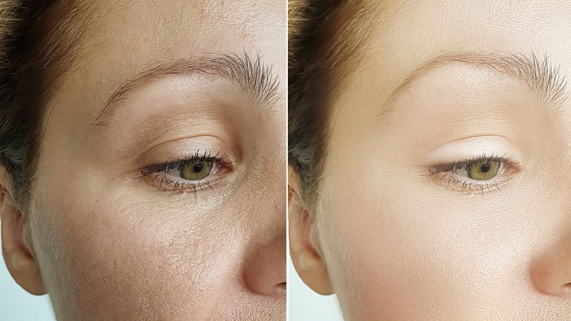 Blepharoplasty before and after-4