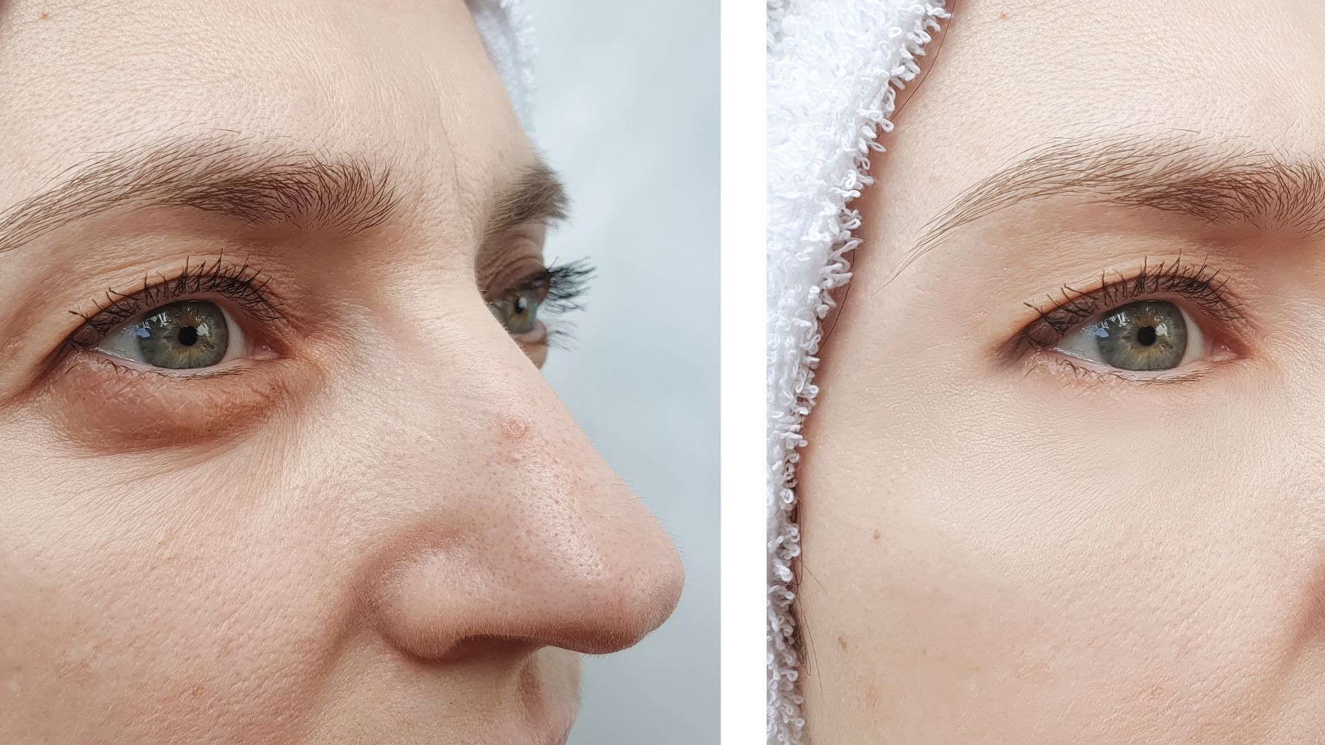 Blepharoplasty before and after-5