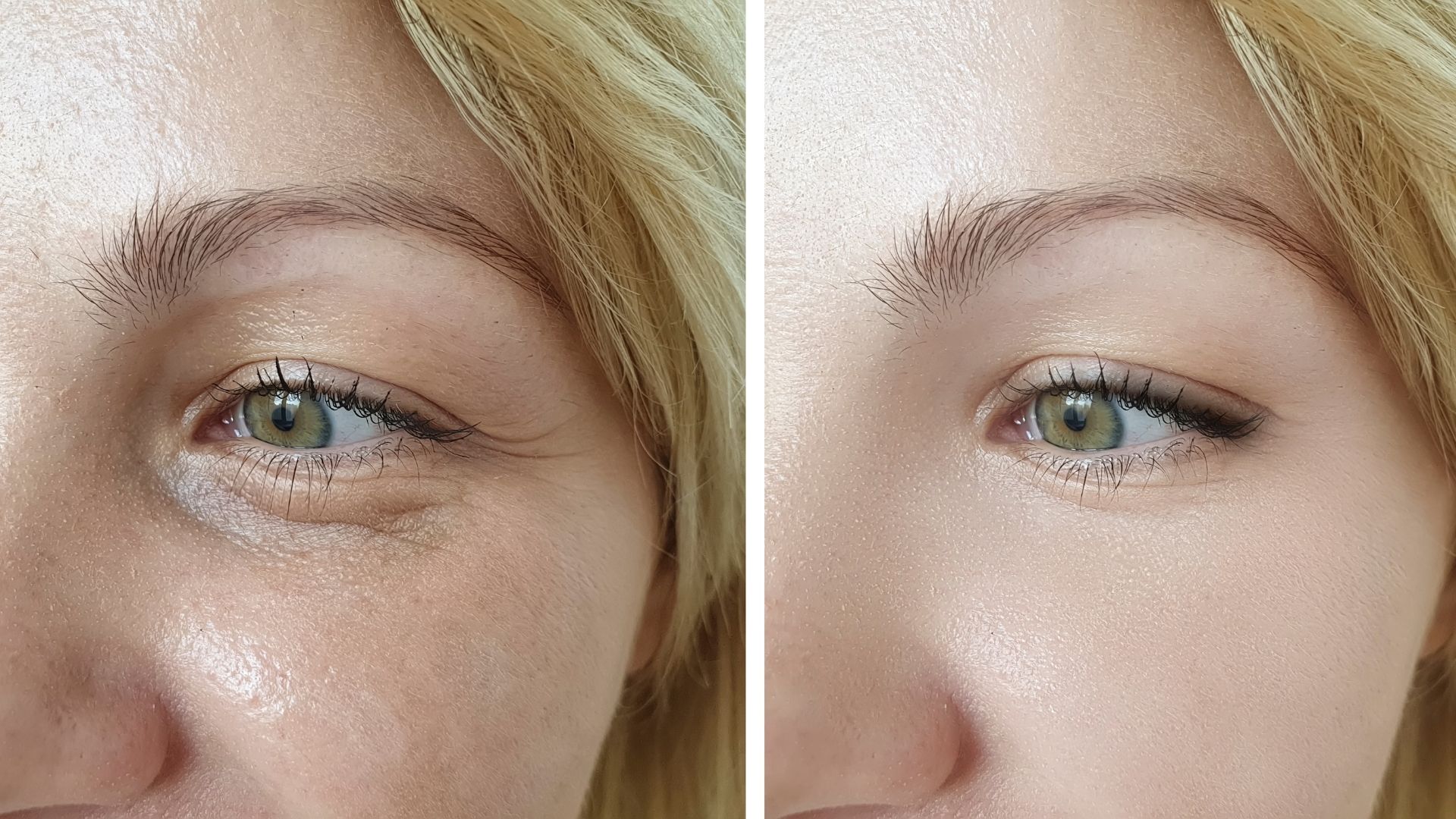 Blepharoplasty before and after-6