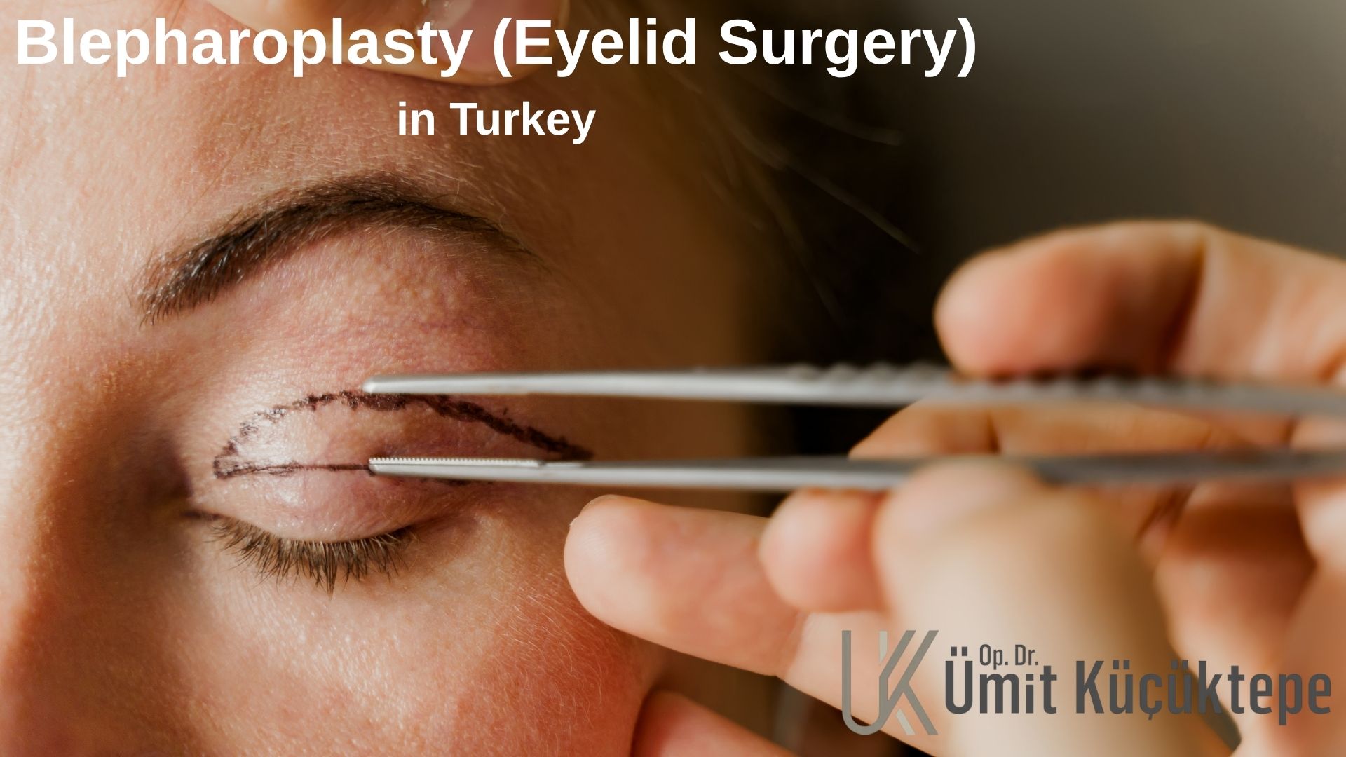 Blepharoplasty (Eyelid Surgery) in Turkey, Antalya 