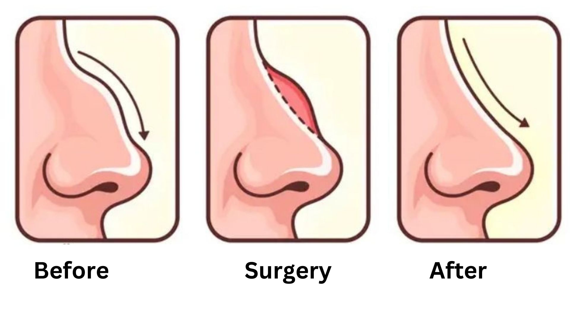 Soften Nasal Bridge-turkey-antalya