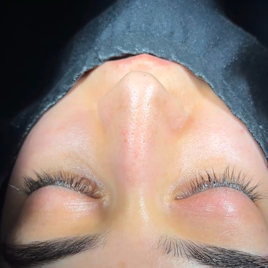 arched nose surgery before after-1