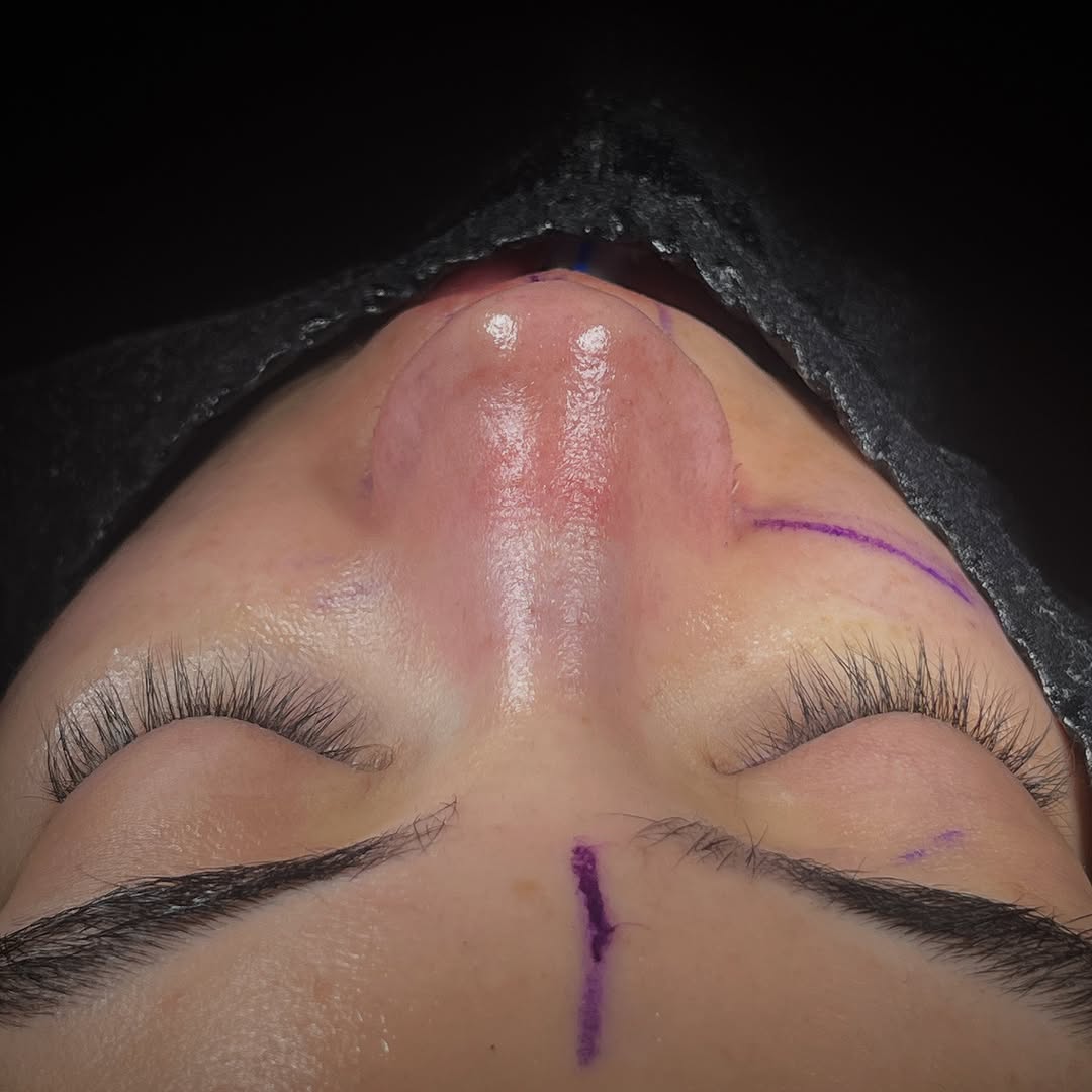 arched nose surgery before after-2