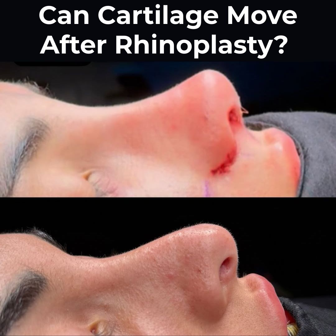 can-cartilage-move-after-rhinoplasty