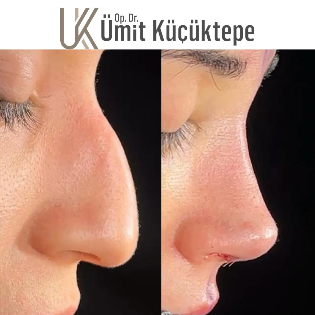 faq-in-rhinoplasty