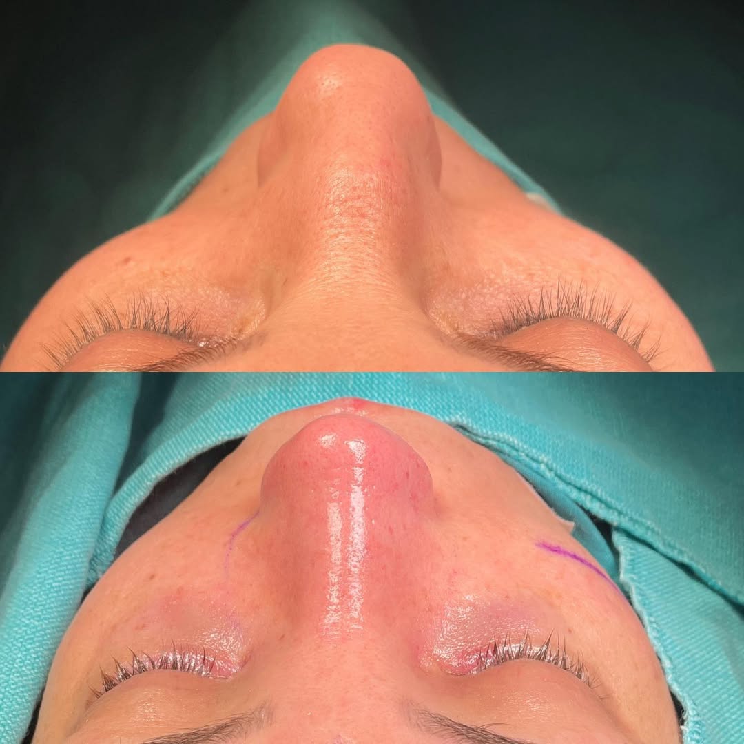 nasal bone curvature before after nasal bone curvature before after