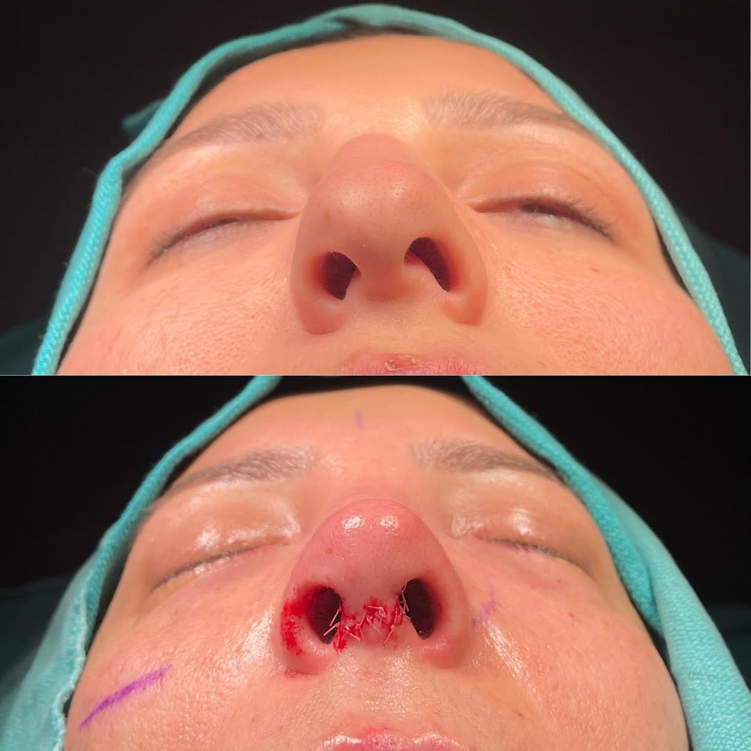 nasal bone curvature before after-1 nasal bone curvature before after-1