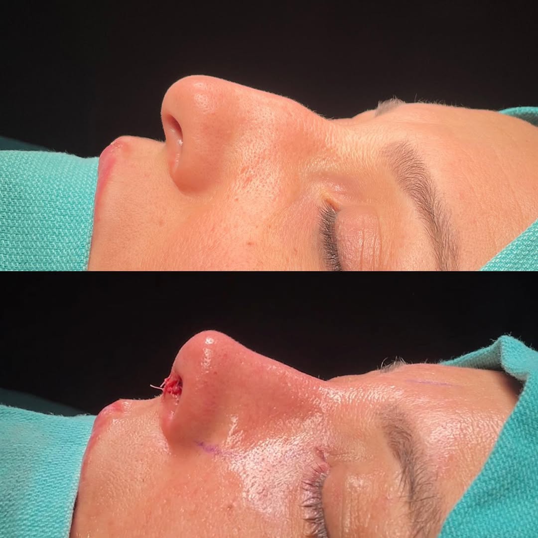 nasal bone curvature before after-2 nasal bone curvature before after-2