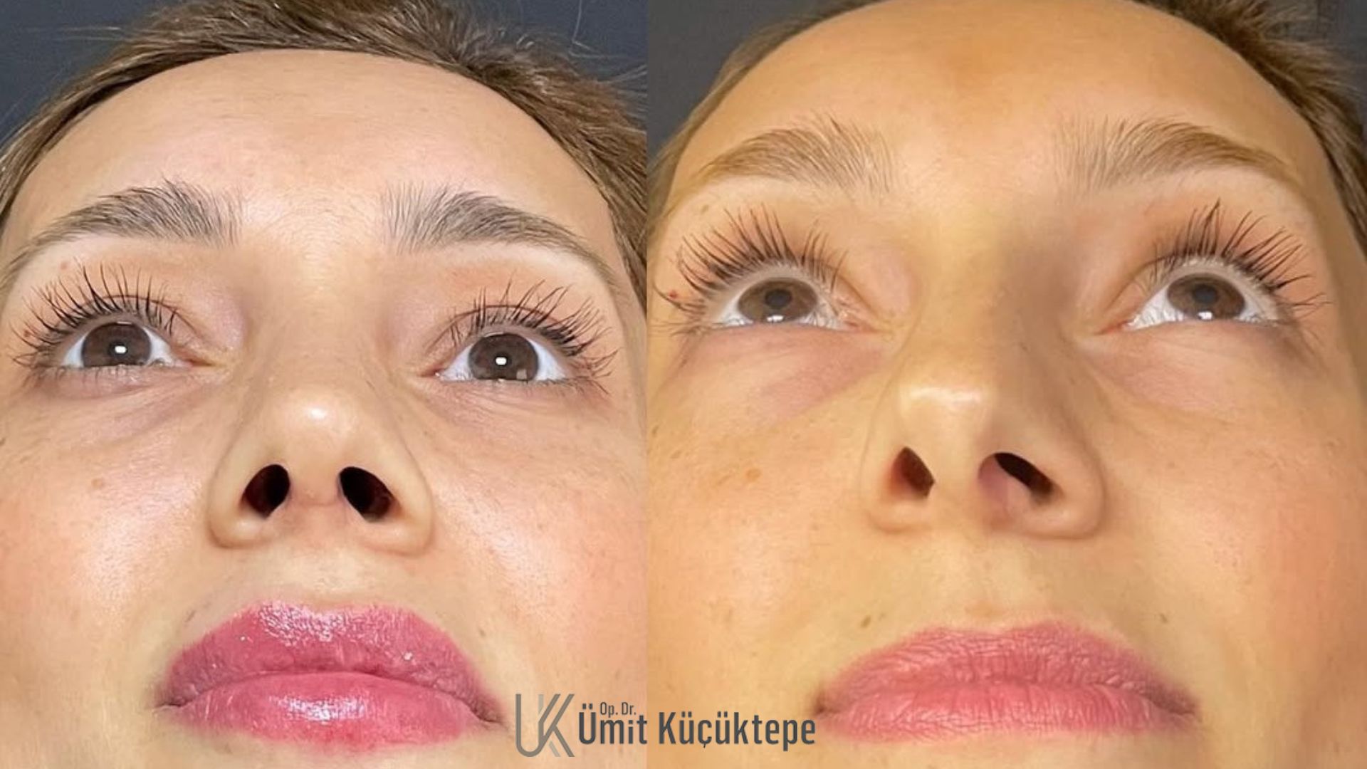 factors-affecting-rhinoplasty-cost-in-turkey-antalya