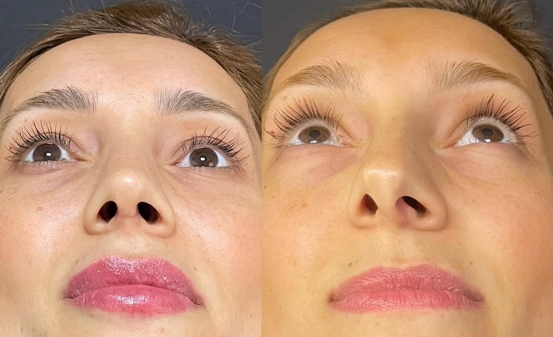 Is nasal bone curvature (deviated septum) a serious issue? Is nasal bone curvature (deviated septum) a serious issue? in Turkey Antalya