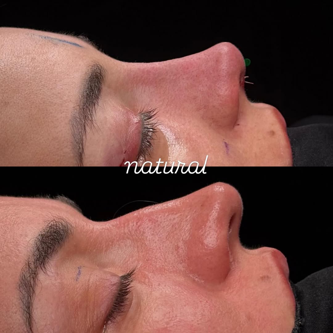 natural-rhinoplasty-turkey-antalya-before-after-1