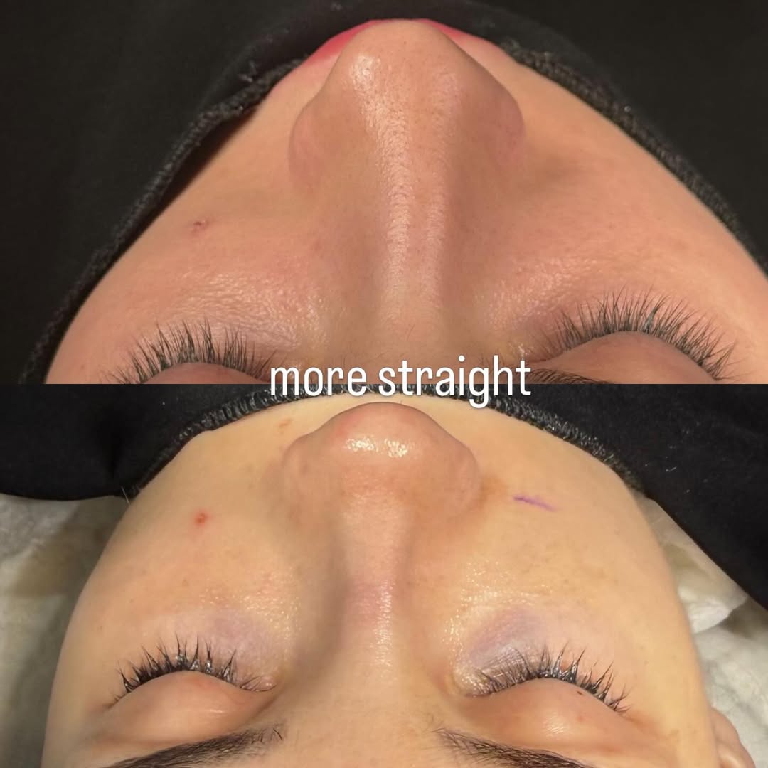 natural-rhinoplasty-turkey-antalya-before-after-4