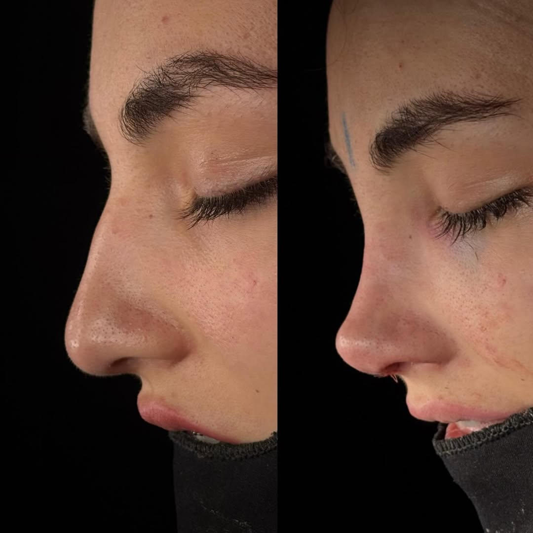 natural-rhinoplasty-turkey-antalya-before-after-5