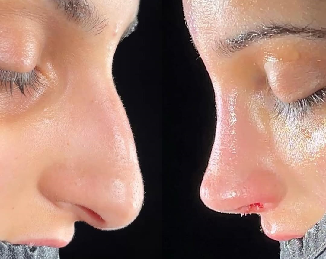 How much does the nose shrink after rhinoplasty?