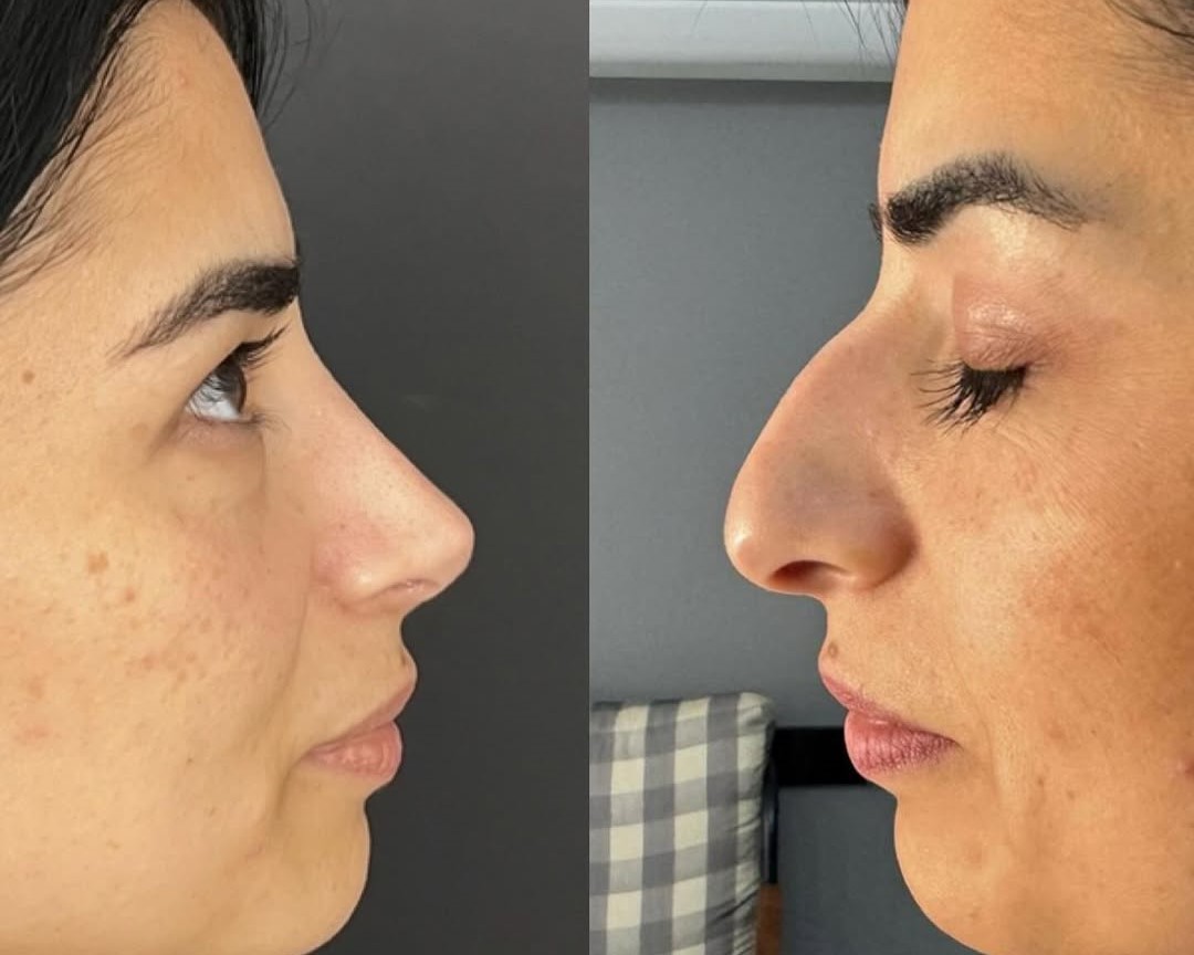 1-year rhinoplasty results