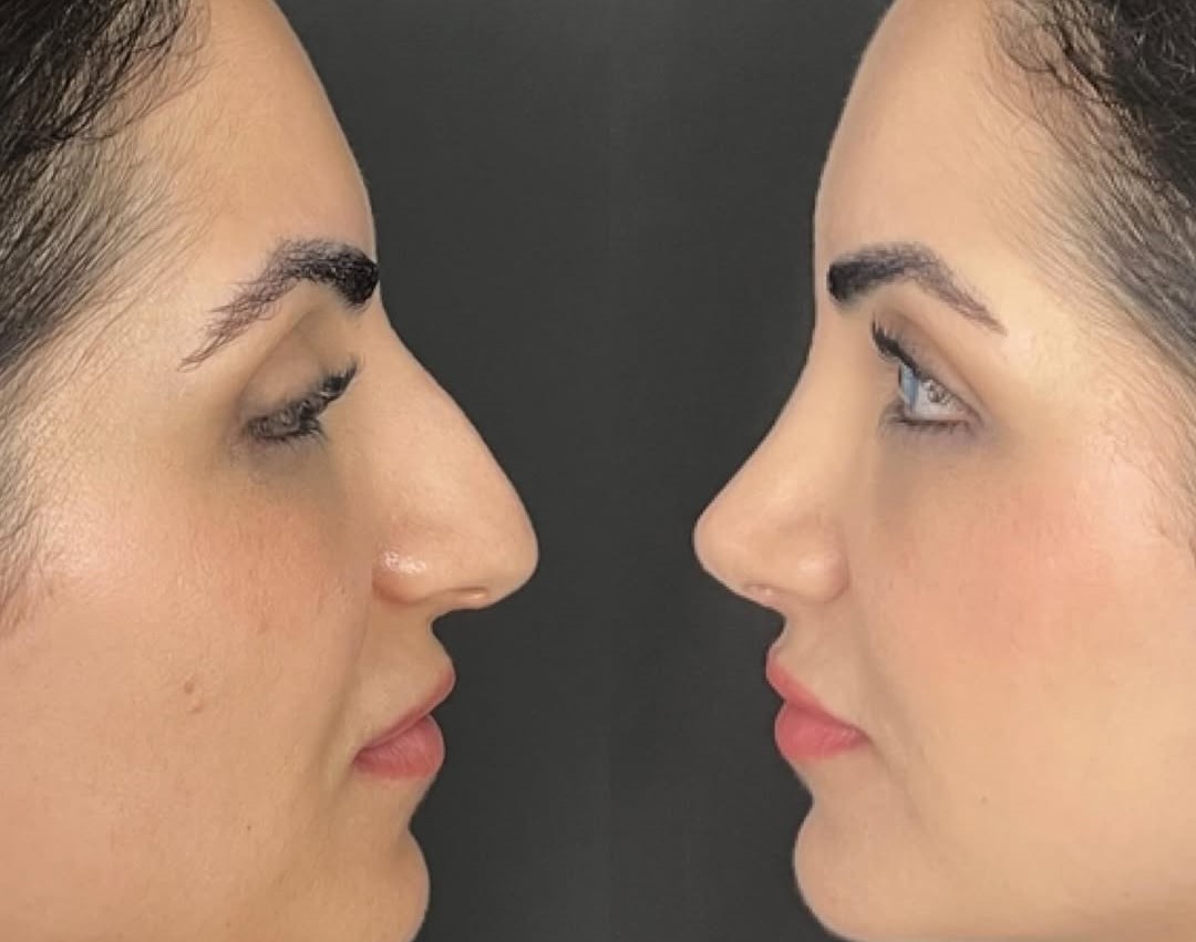 1-year rhinoplasty results