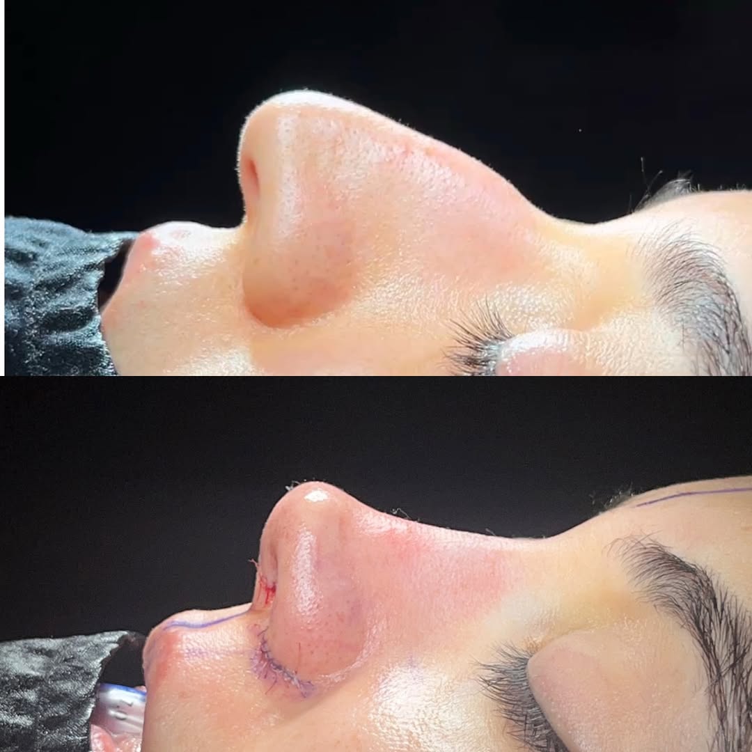 How to fix nose tip drop? How to fix nose tip drop?-turkey, Antalya