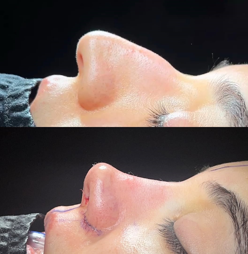 Nose tip aesthetics in Turkey, Antalya