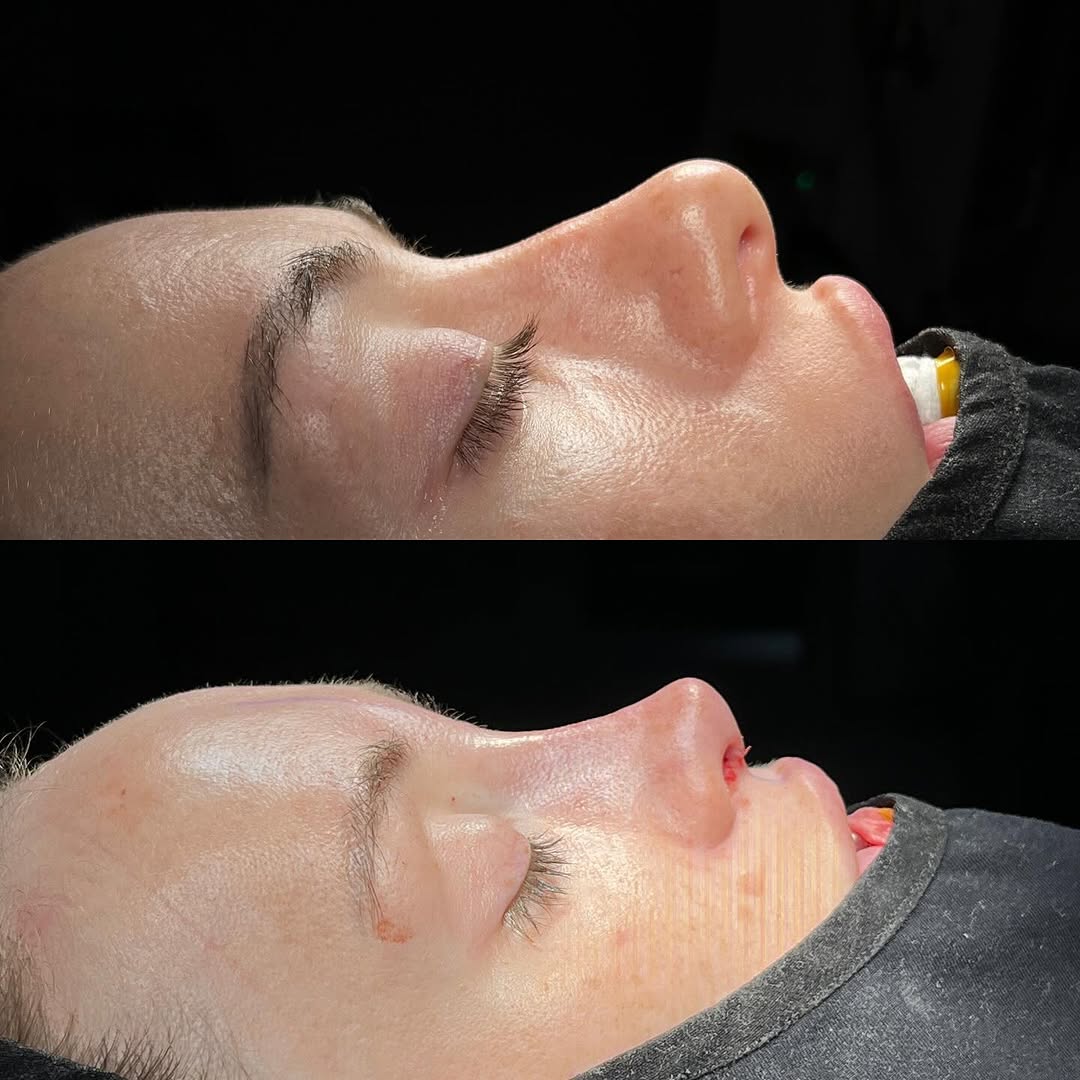 Nose tip aesthetics in Turkey, Antalya