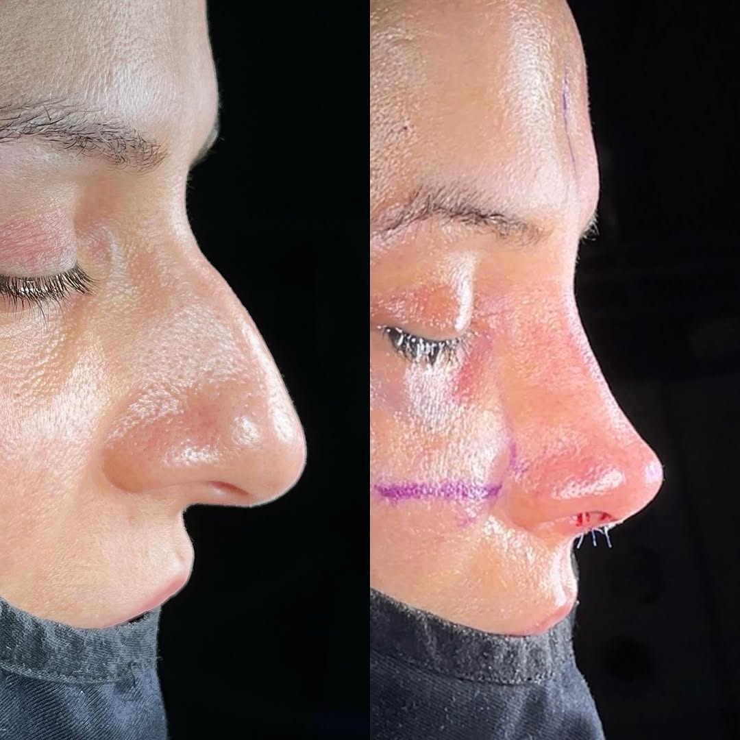 Nose tip aesthetics in Turkey, Antalya