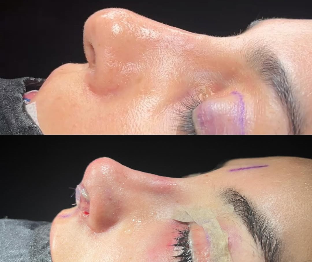 why do we need nostril-retainer use? 