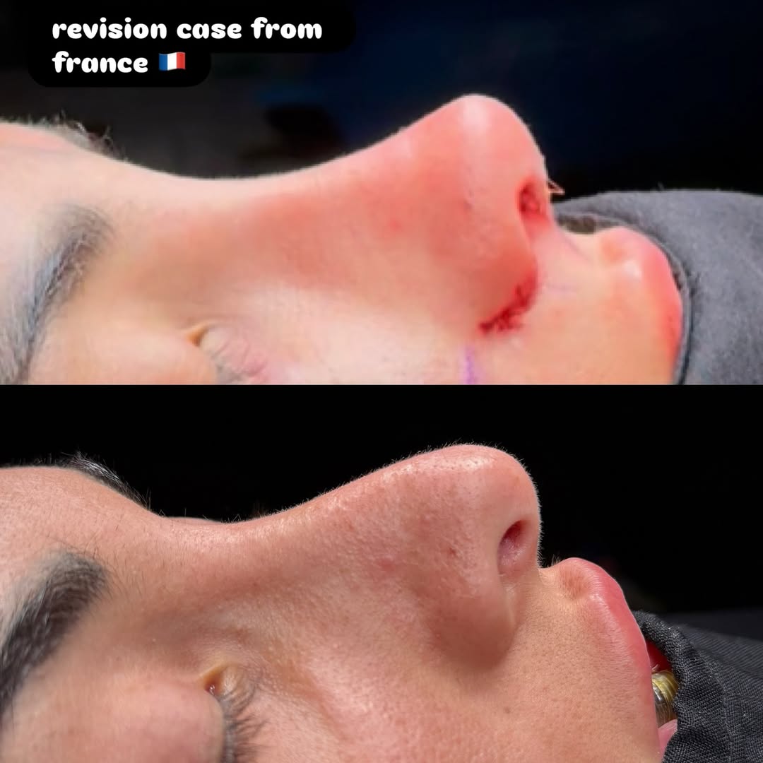 Revision rhinoplasty for Pollybeak deformity