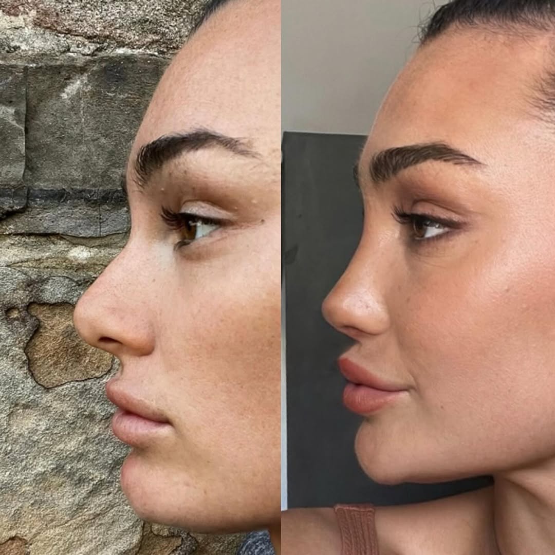 3 months post-surgery