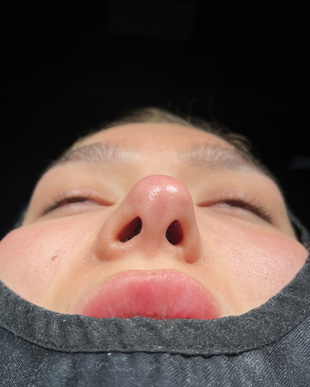 Revision Rhinoplasty Before and After-1 Revision Rhinoplasty Before and After-1