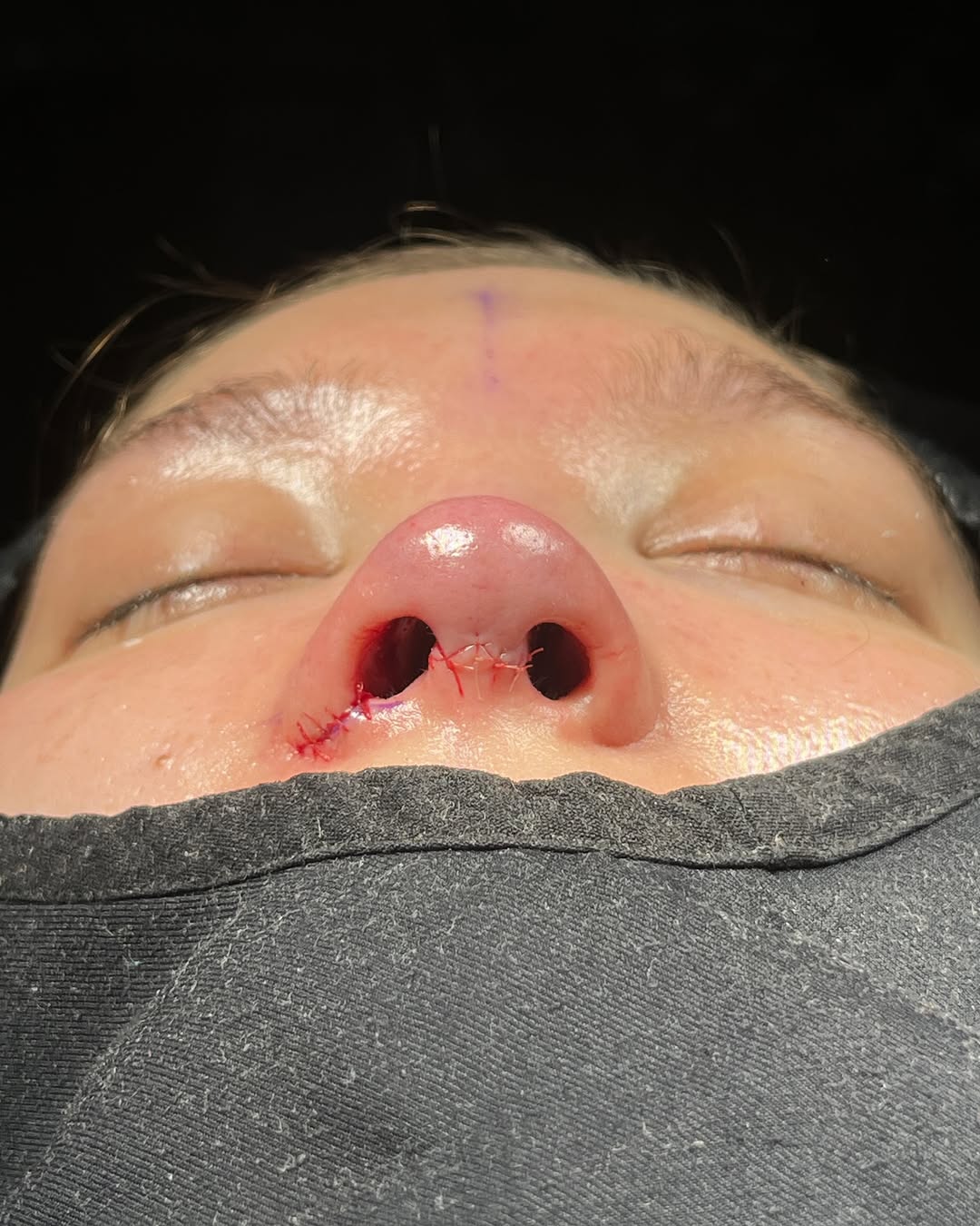 Revision Rhinoplasty Before and After-2 Revision Rhinoplasty Before and After-2