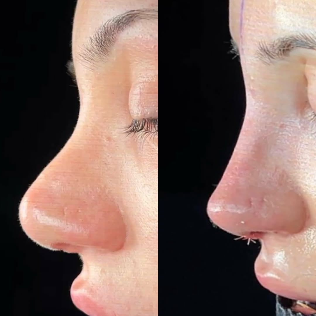 Is it possible to have the third rhinoplasty? Is it possible to have the third rhinoplasty?