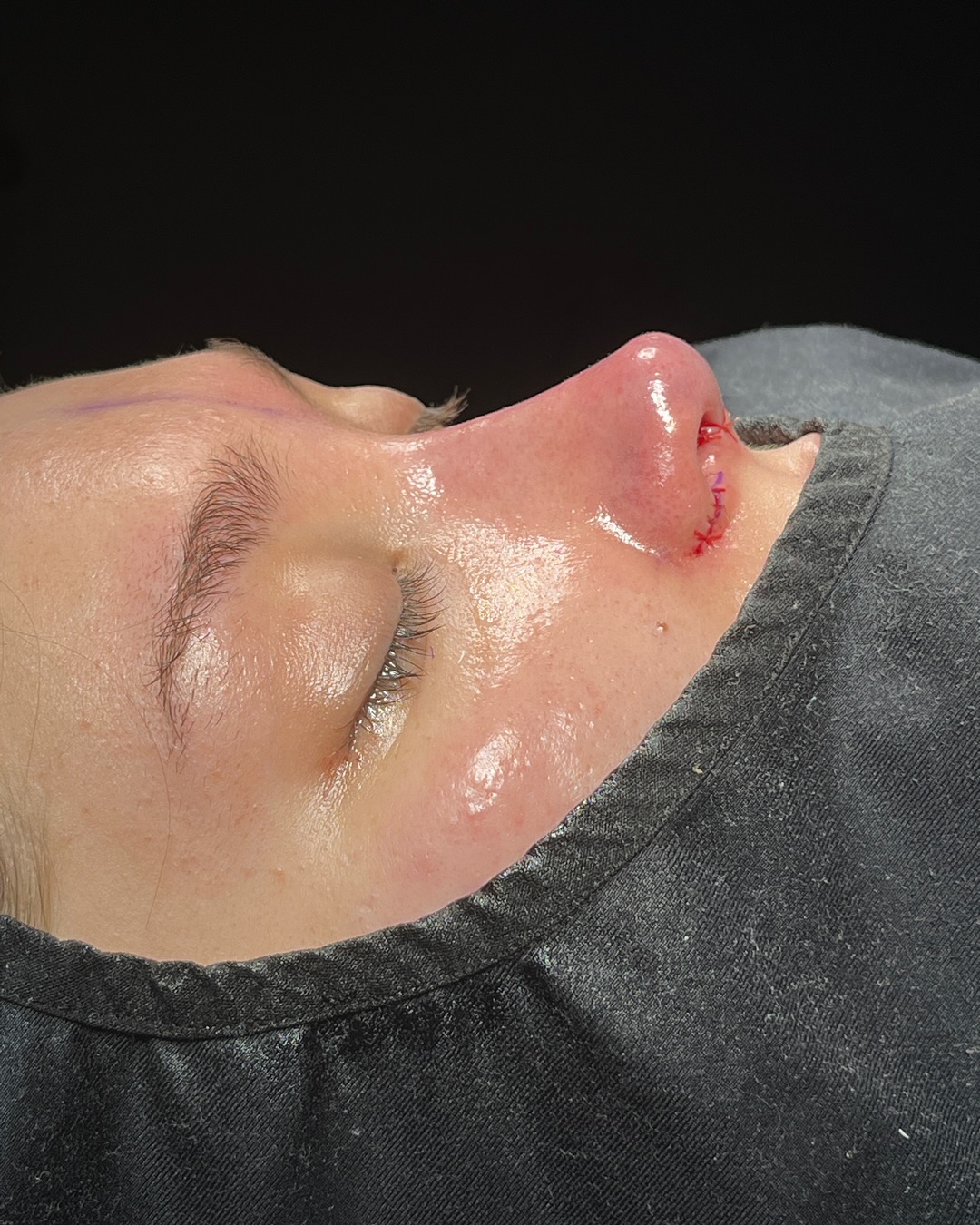 Revision Rhinoplasty Before and After-4 Revision Rhinoplasty Before and After-4