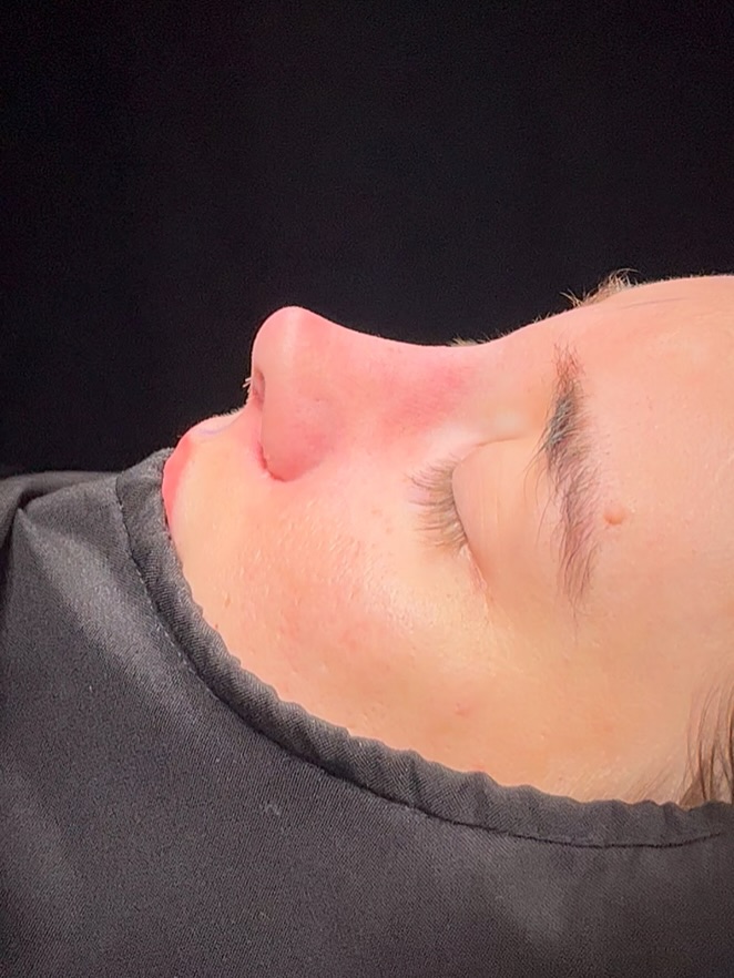 Revision Rhinoplasty Before and After-6 Revision Rhinoplasty Before and After-6