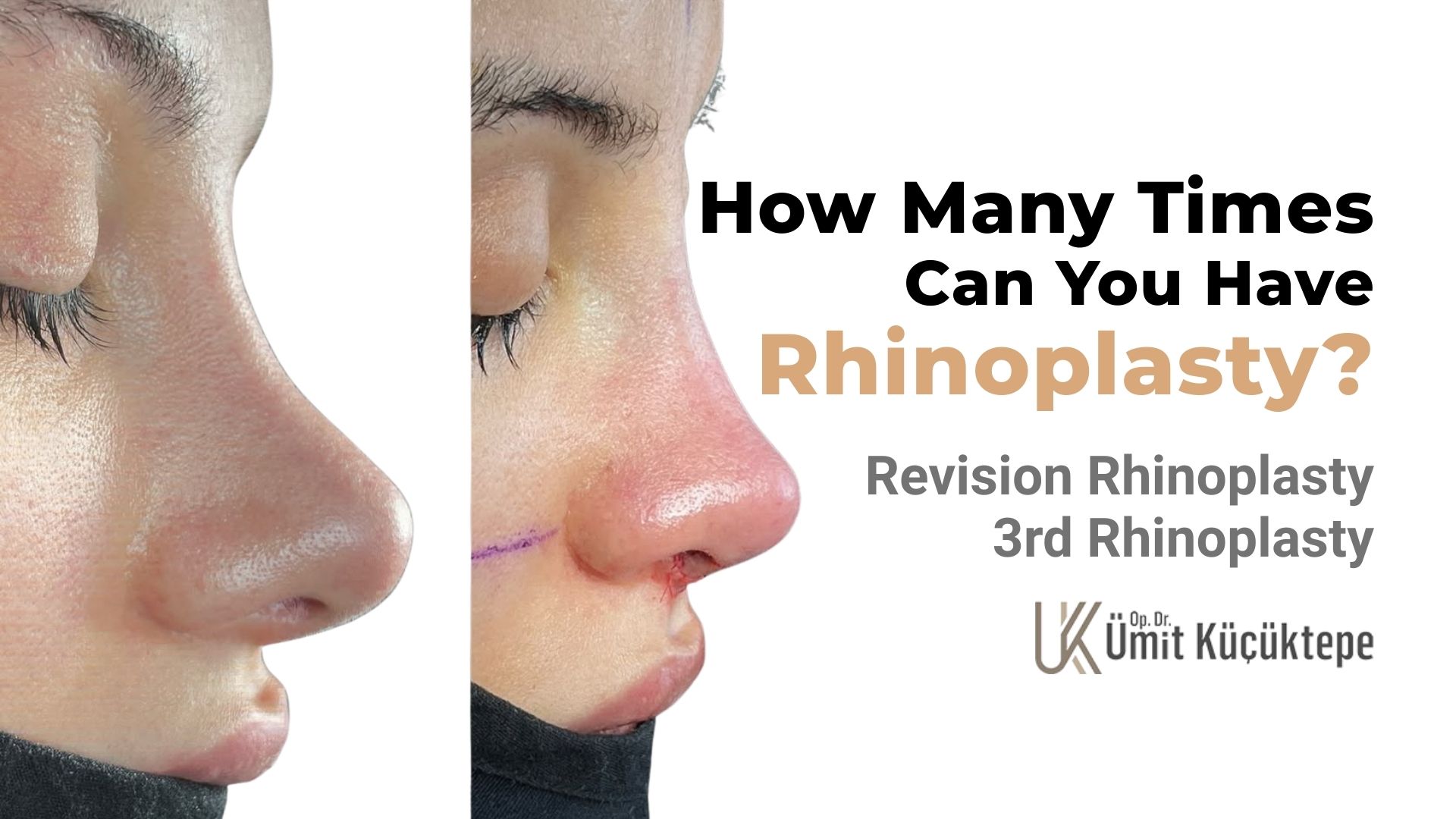 how-many-times-can-you-have-rhinoplasty?
