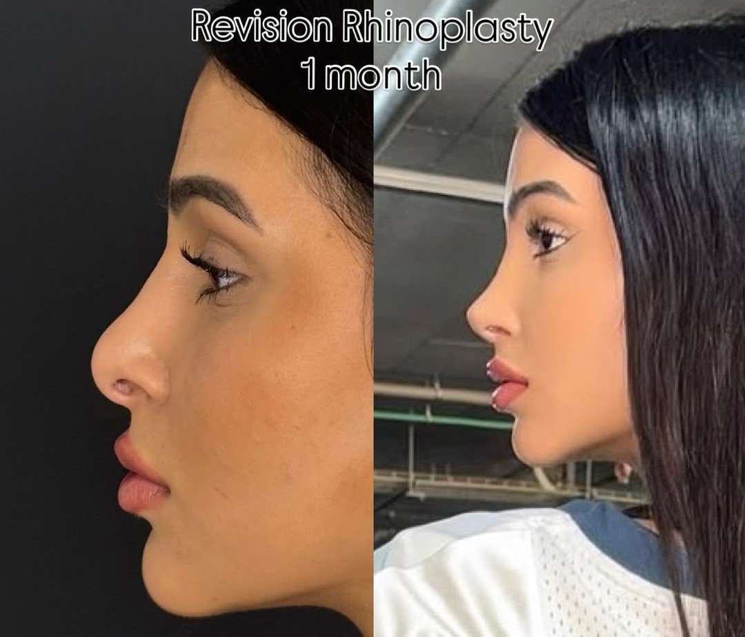 Rhinoplasty 1 Month result