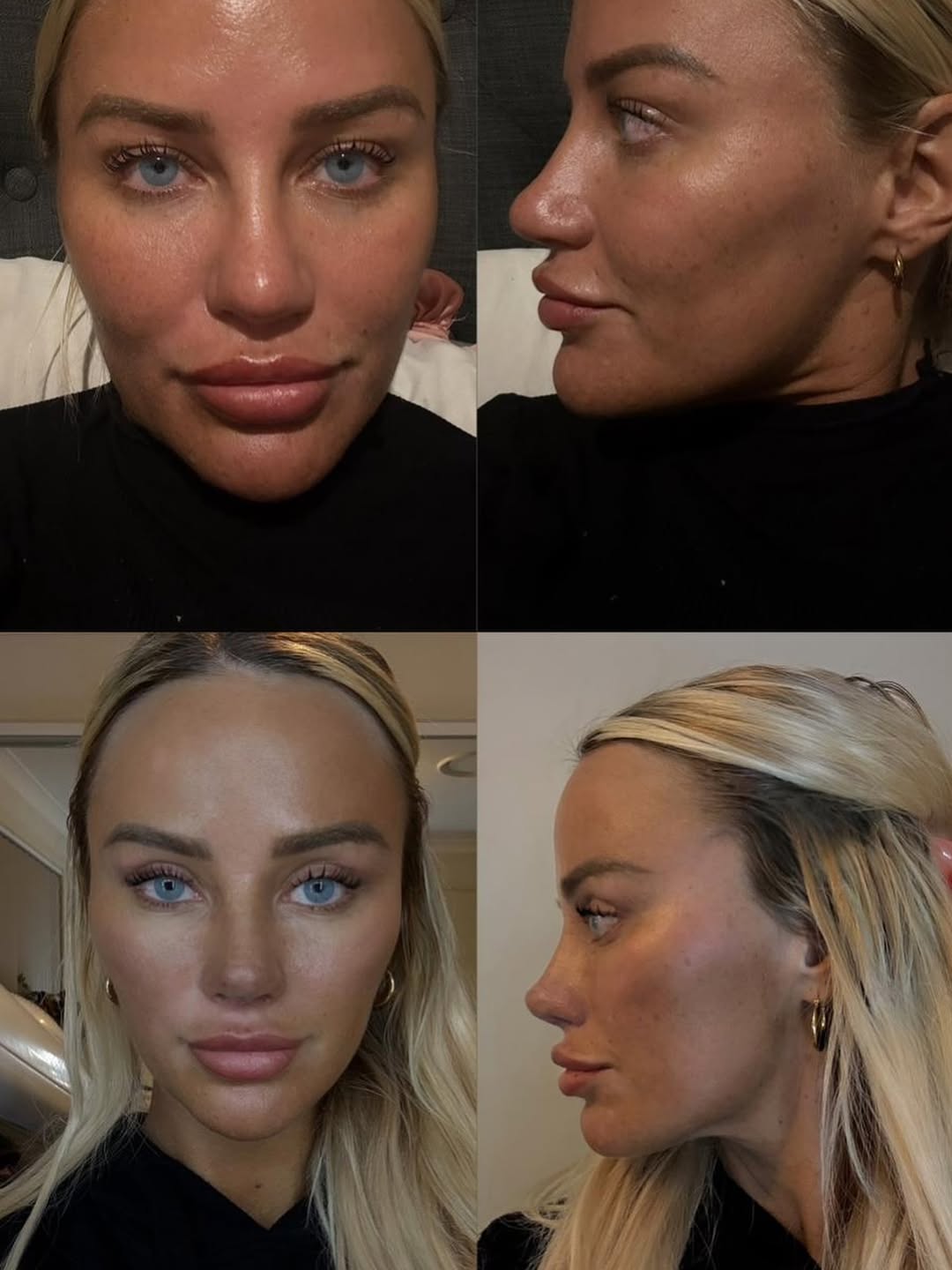 Revision rhinoplasty combined with an endoscopic midface lift Revision rhinoplasty combined with an endoscopic midface lift