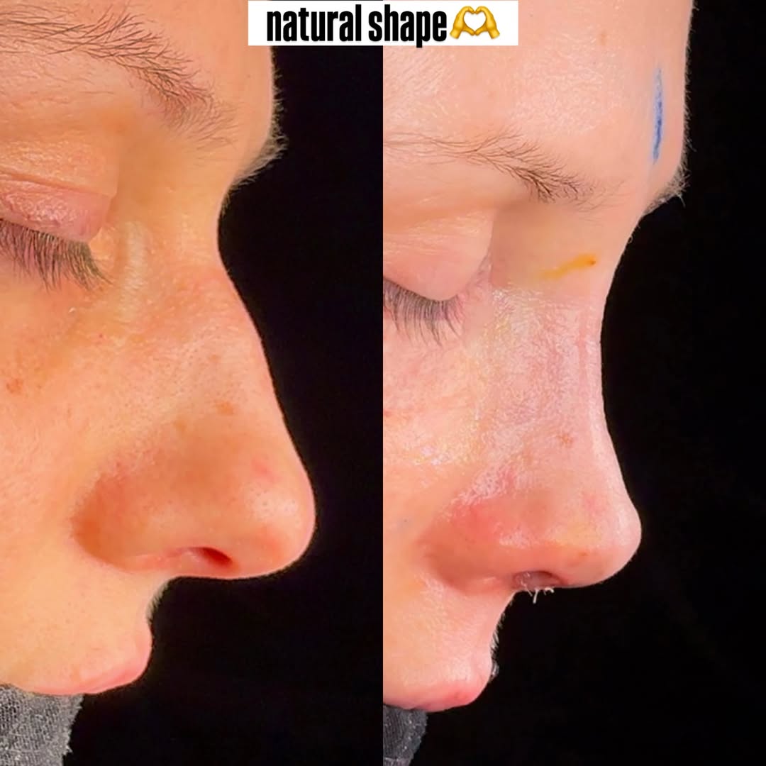 Natural nose shape Natural nose shape