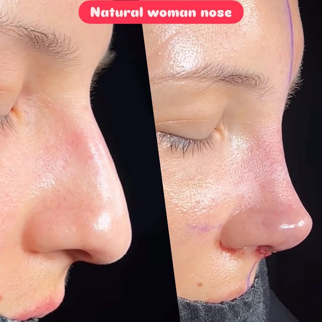 Natural nose Natural nose