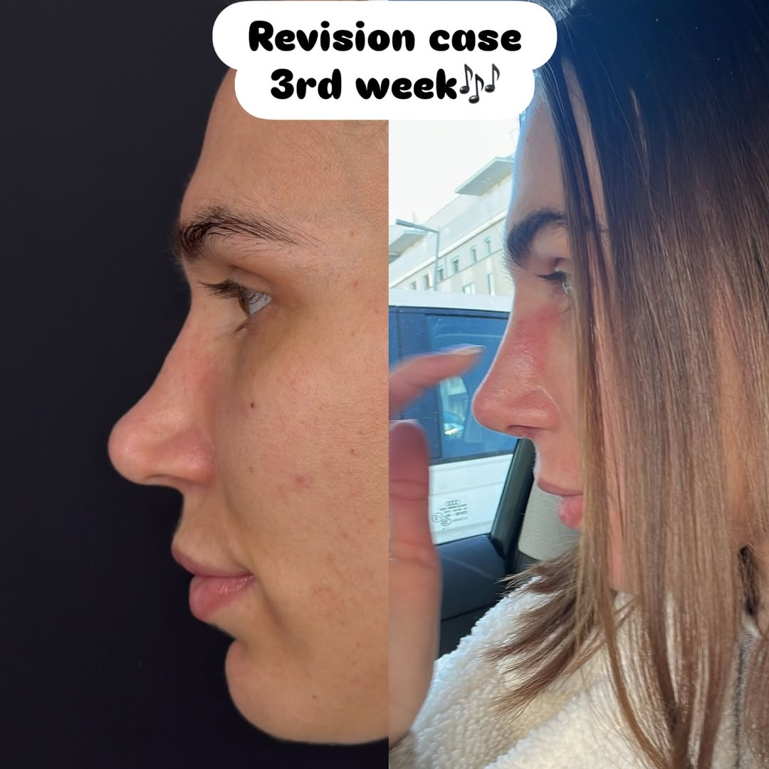 Revision case with own rib cartilage Revision case with own rib cartilage
