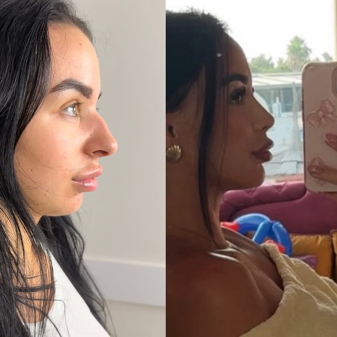Rhinoplasty Long Term Results-1 Rhinoplasty Long Term Results-1
