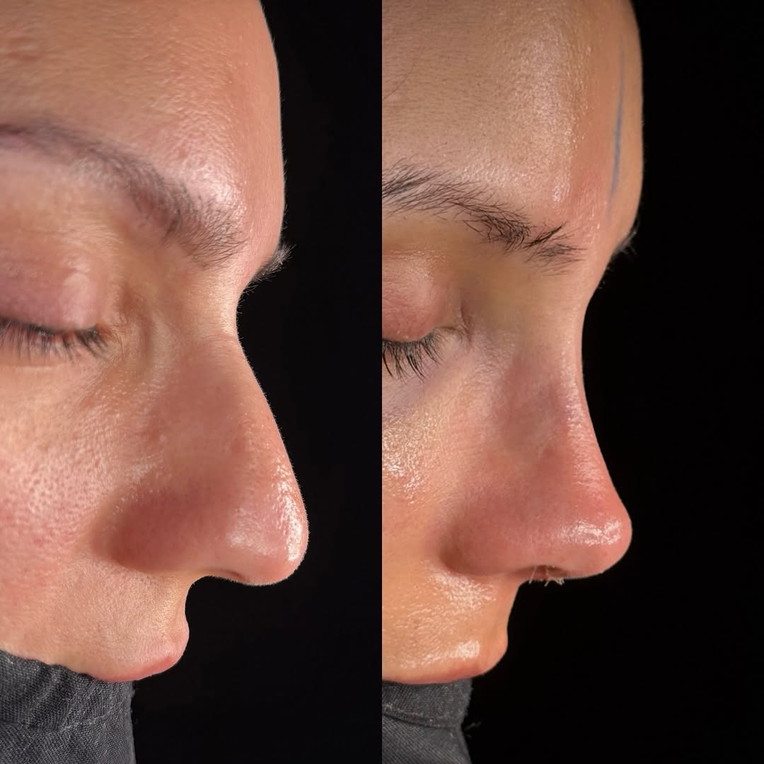 Deprojection nose surgery Deprojection nose surgery