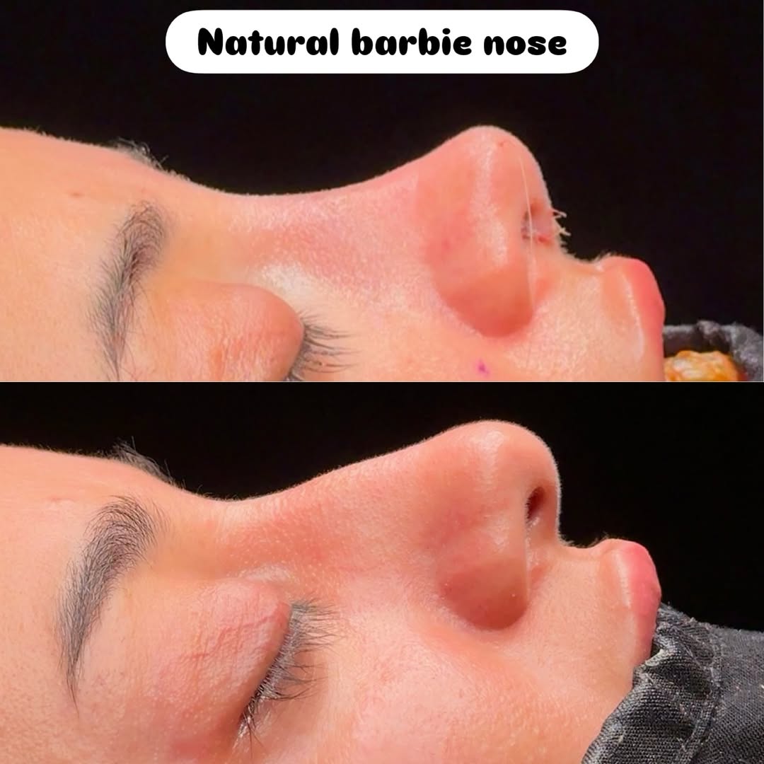 Natural Barbie nose style-1 Natural Barbie nose style-1