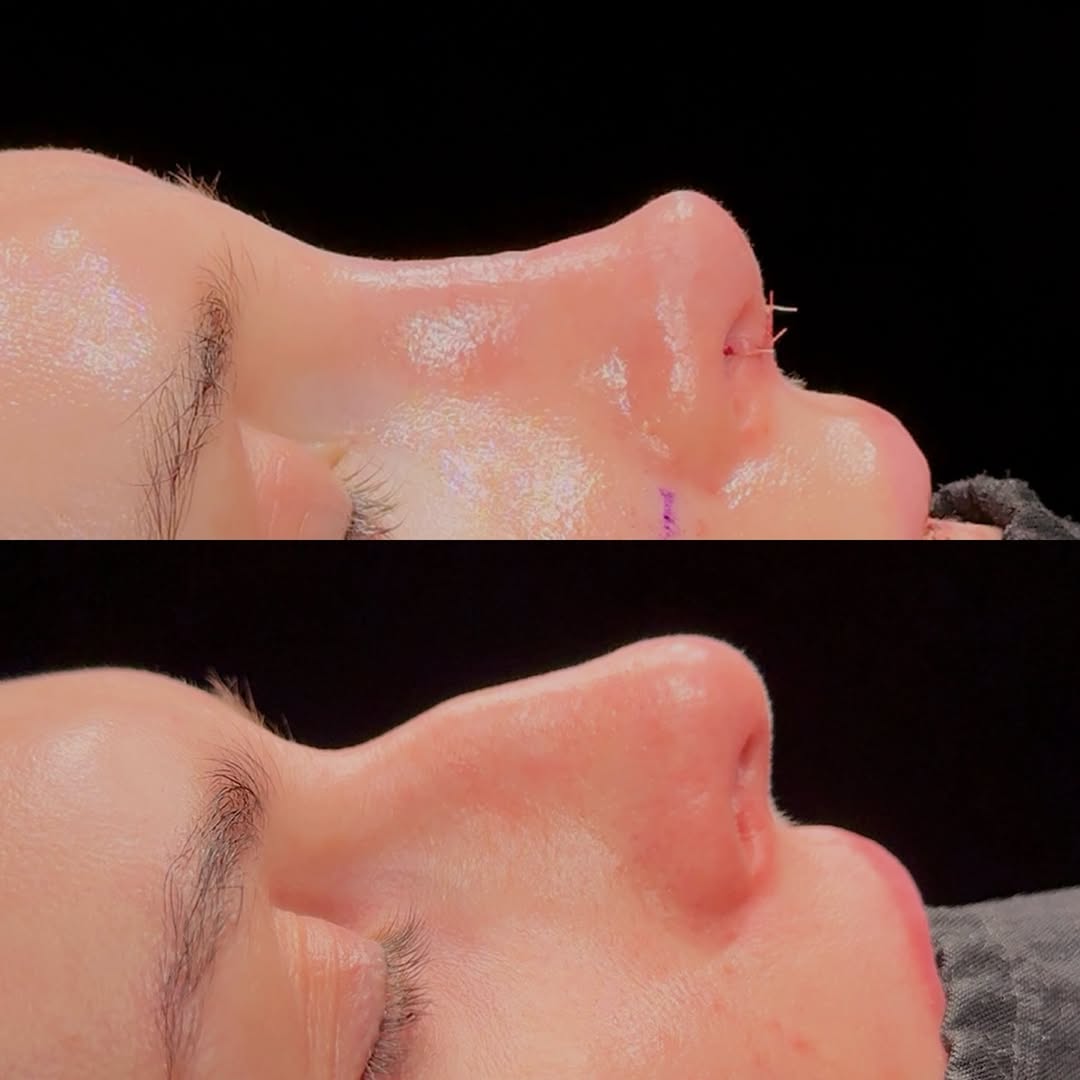 Primary Rhinoplasty Primary Rhinoplasty