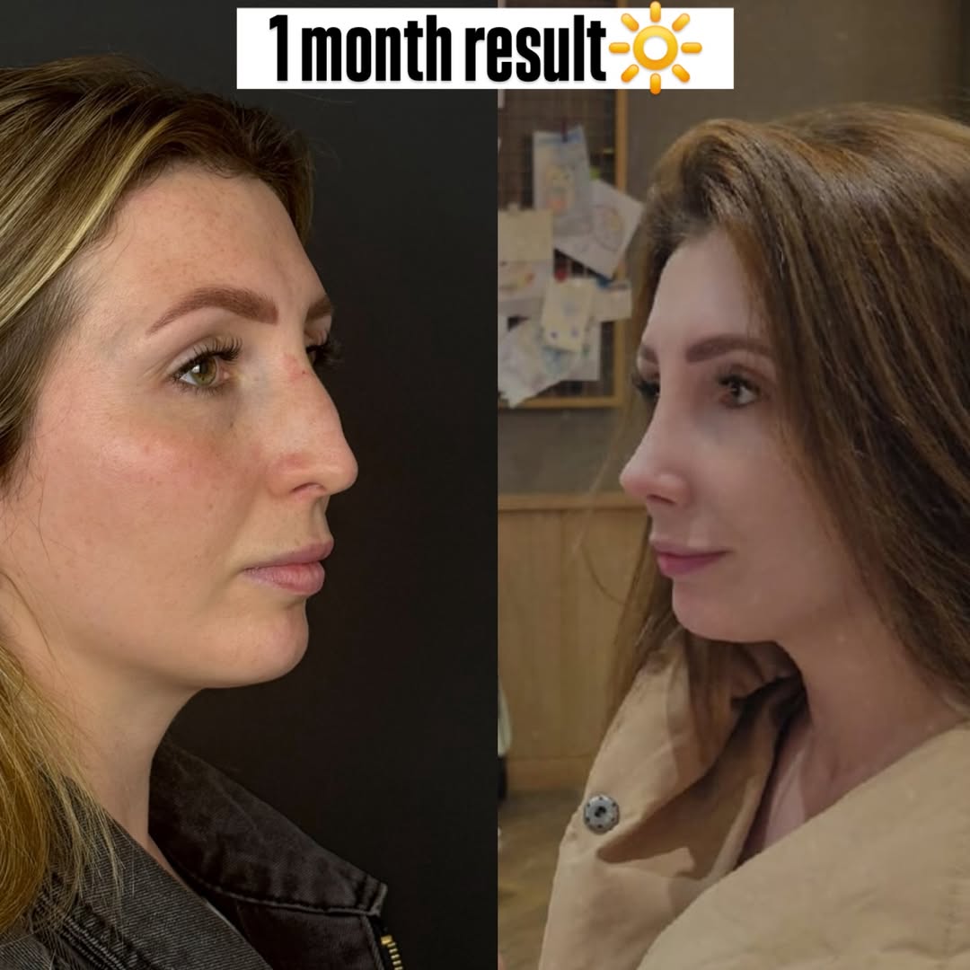 Rhinoplasty: 1 month result Rhinoplasty: 1 month result