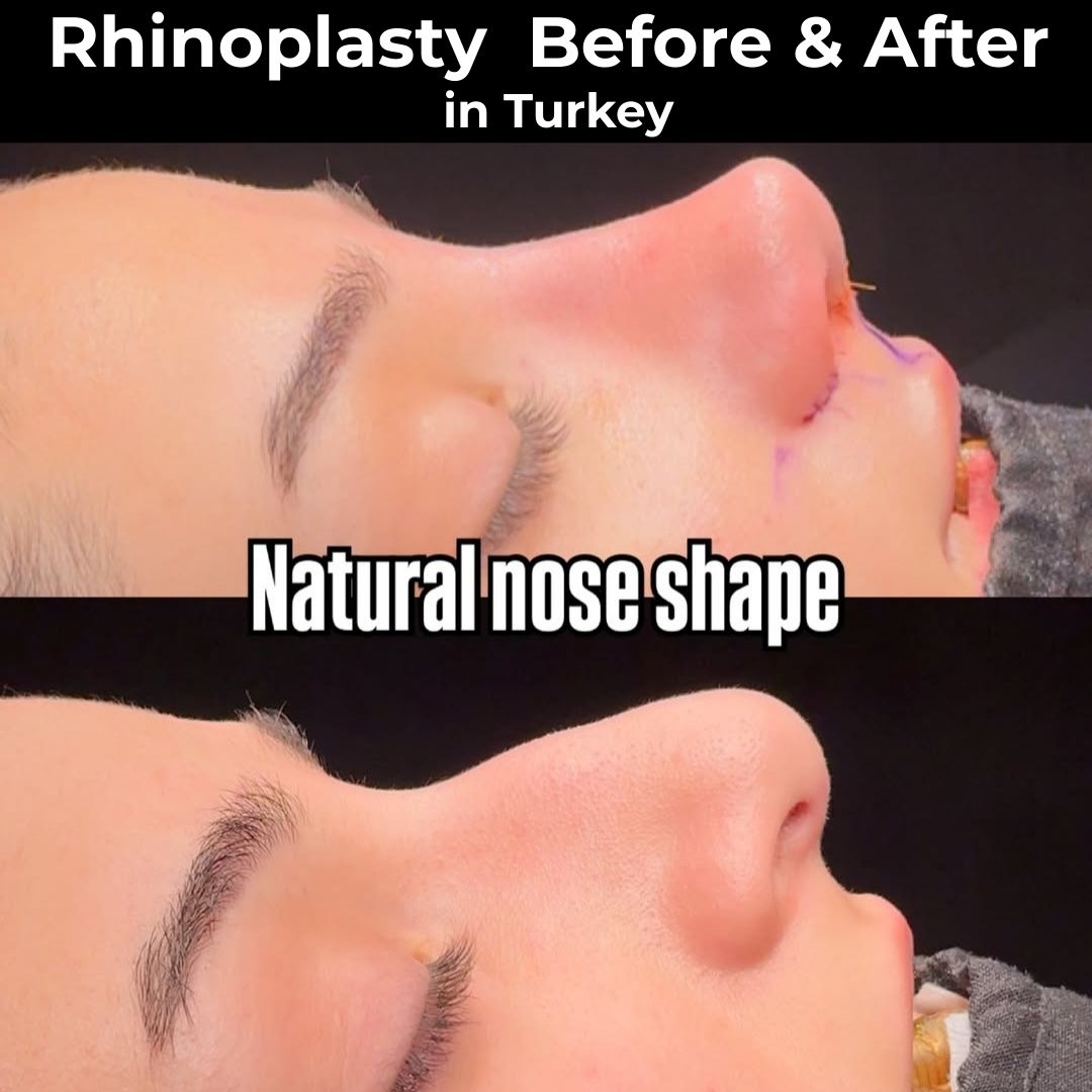 rhinoplasty-before-and-after-in-turkey-antalya