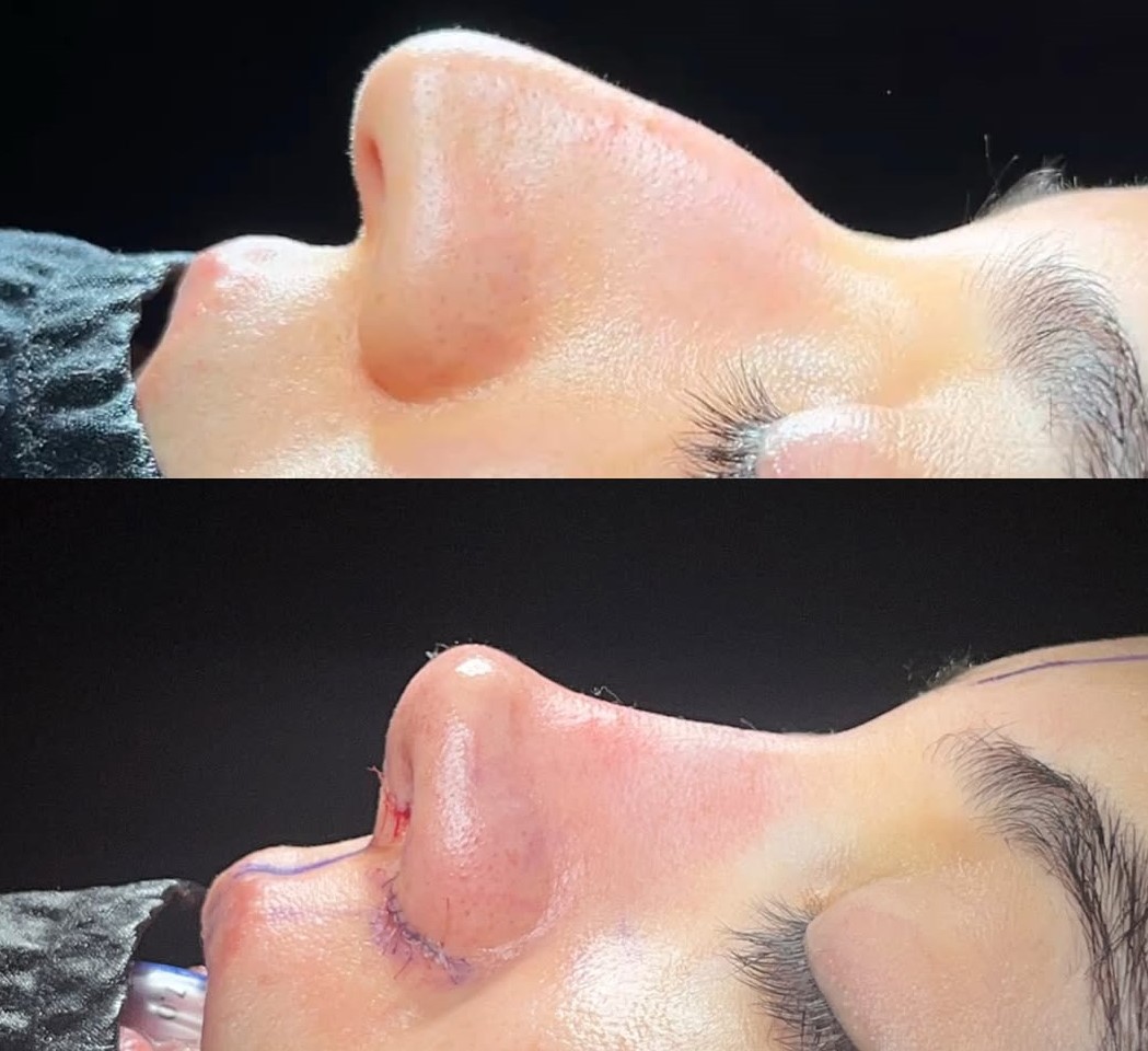 The complexity of your nose job procedure. in Turkey Antalya