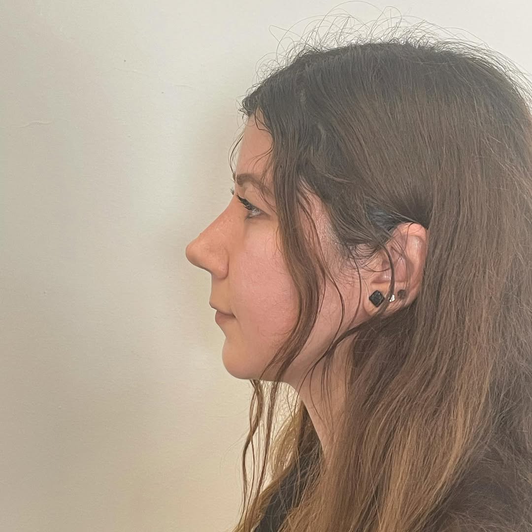 piezo-rhinoplasty-4