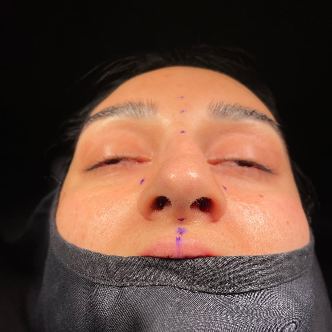 ultrasonic-rhinoplasty-8